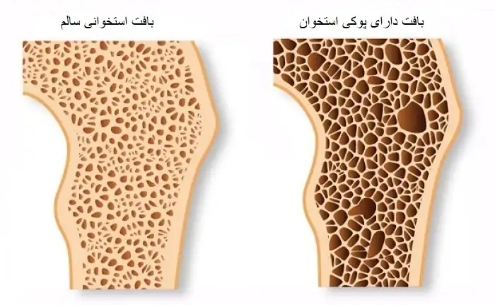 مقایسه استخوان سالم و بافت دارای پوکی استخوان