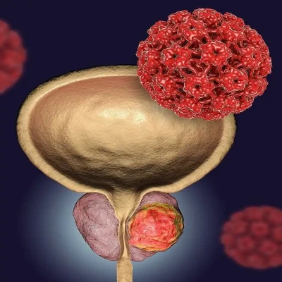 علائم، پیشگیری و درمان سرطان پروستات