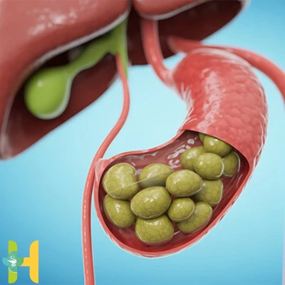 نگاهی به بیماری سنگ کیسه صفرا؛ [تشخیص، پیشگیری و روش‌های درمانی]