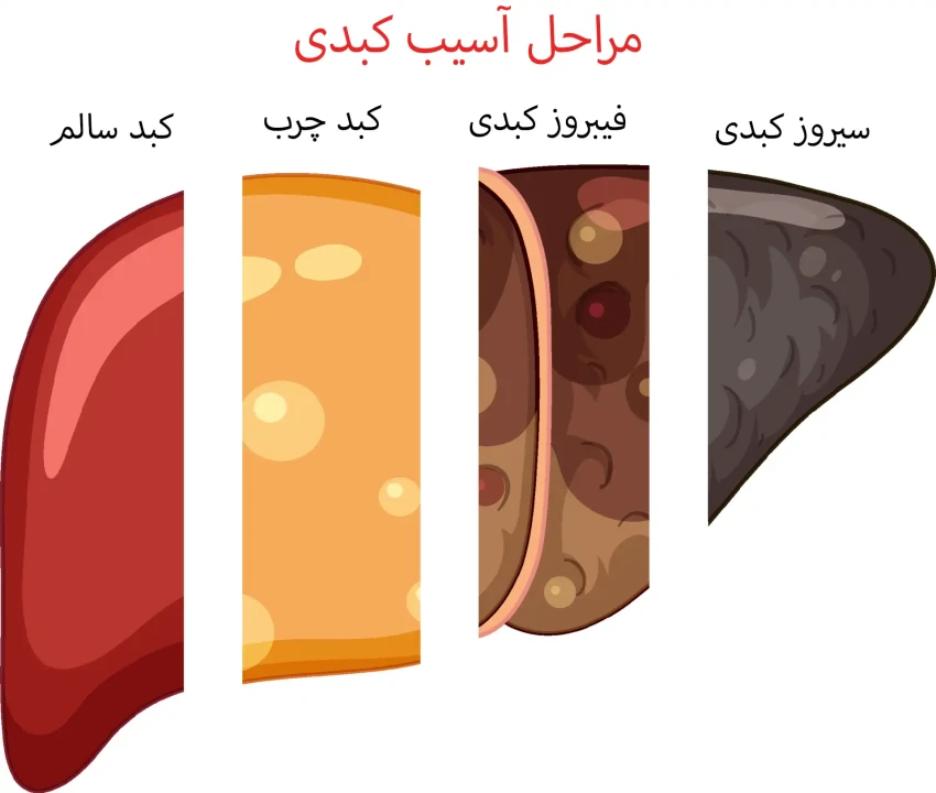 جدیدترین یافته‌ها درباره کبد چرب غیر الکلی در سال 2024
