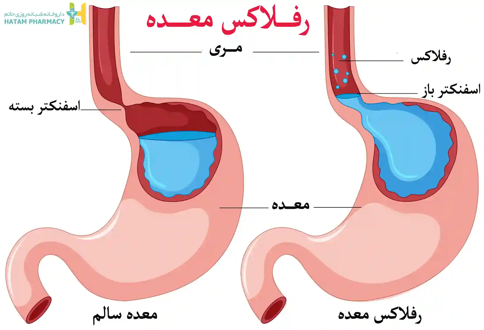 رفلاکس اسید معده